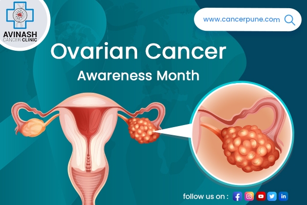 Ovarian Cancer Awareness Month: Symptoms, Causes, and Treatment